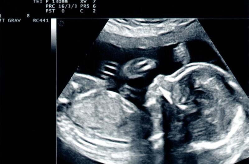 Kluczowe informacje dotyczące ultrasonografii podczas ciąży